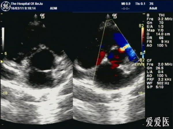 室间隔缺损? - 超声医学讨论版 - 爱爱医医学论坛