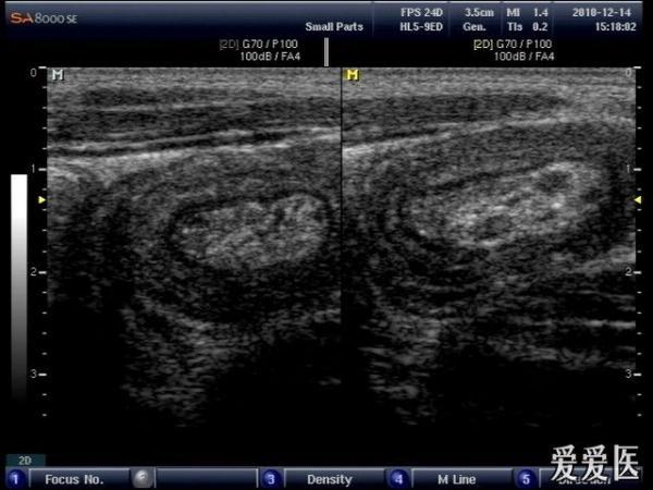 经典肠套叠 - 超声医学讨论版 - 爱爱医医学论坛 - 爱爱医医学网