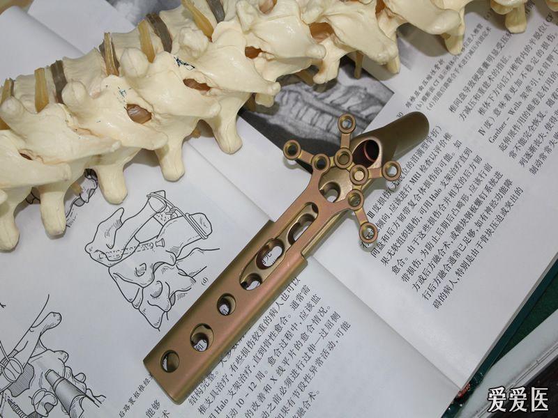 最后一个钢板是进口的星型钢板 dhs可行?这个钢板如何用途?