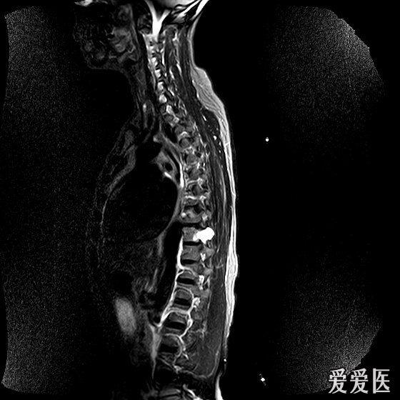 神经源性肿瘤(dr,mri)-病理结果在21楼