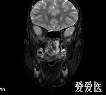 【2011-10】鼻塞5年余(答案已公布,鼻咽纤维血管瘤)