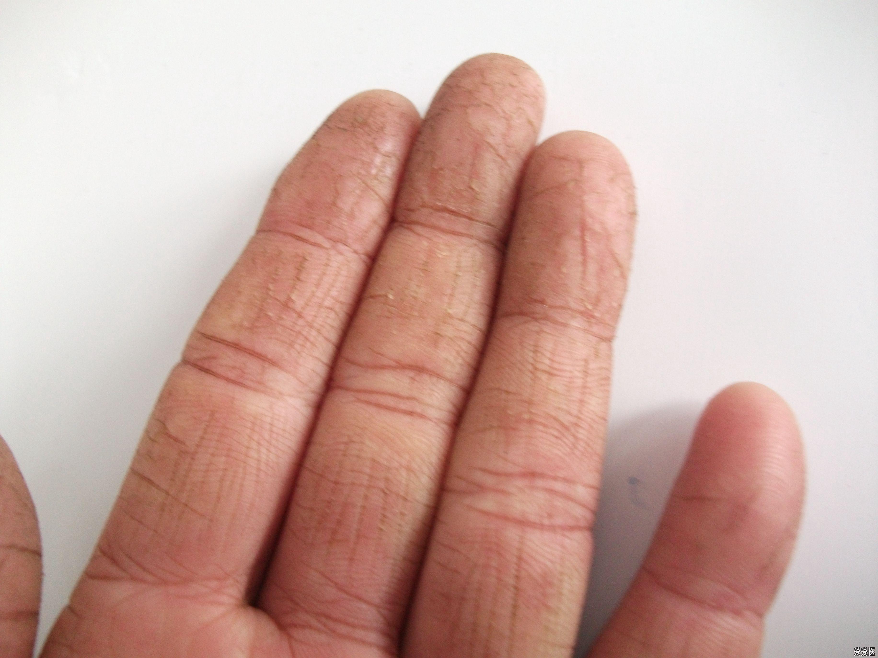 手指皲裂怎么治疗(图片太大已关闭,请按版规发帖-良版4.9)