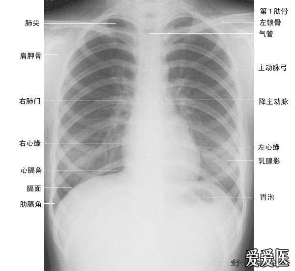 和辐射强度都很大,而年龄越小对x射线越敏感,正常组织收到的伤害越大