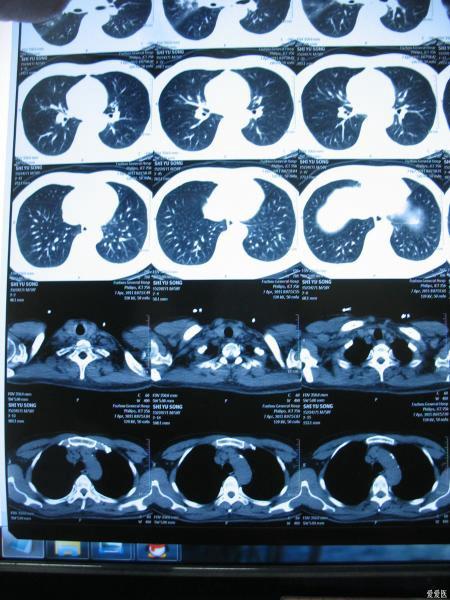 胸部x射线 ct增强片 帮帮忙看一下 是肺癌吗?