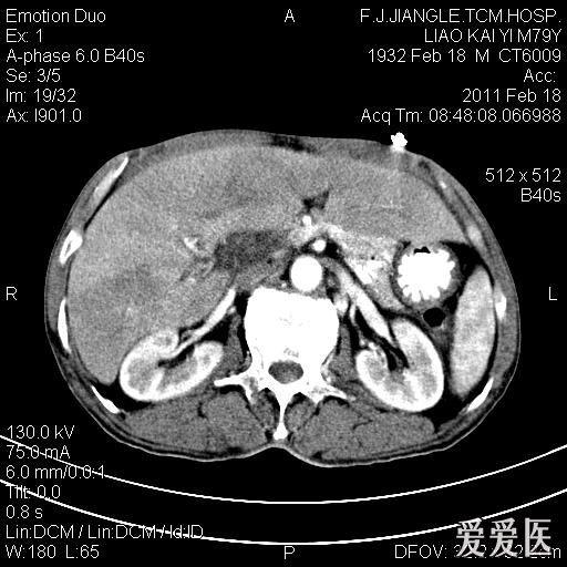 一例确诊的肝脓肿,ct平扫 增强