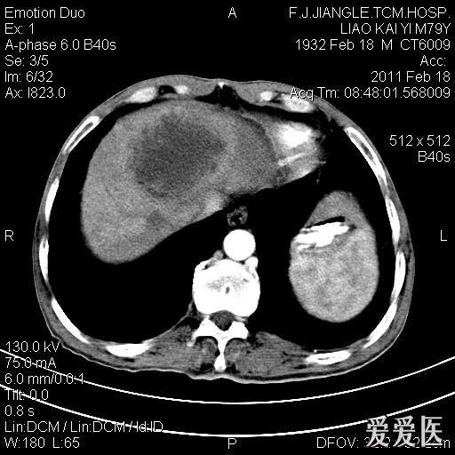 一例确诊的肝脓肿,ct平扫 增强 医学影像学讨论版 爱爱医医学论坛