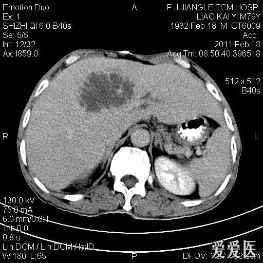 一例确诊的肝脓肿,ct平扫 增强