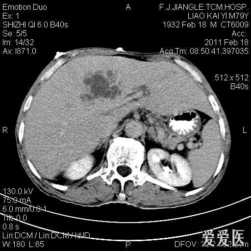 一例确诊的肝脓肿,ct平扫 增强