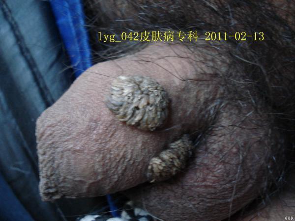 生殖器也会长 寻常疣 !有图为证 - 皮肤及性传播