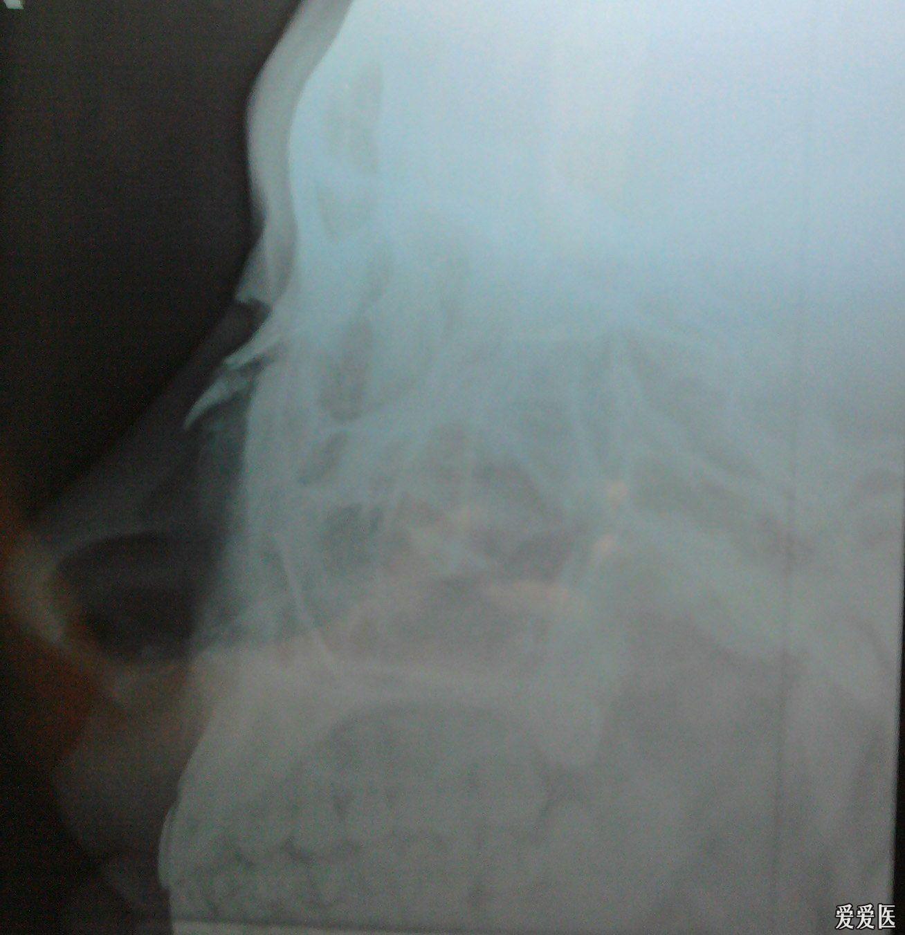 30晚上医院伤后2小时左右照片的结果  x线检查报告单:  片示鼻骨中部