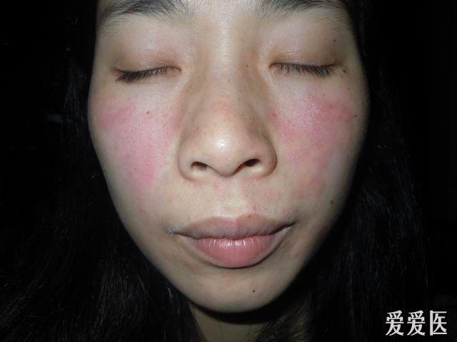 楼主jxyde2011-05-05 20:54:01   女性,28岁,偶发面部红斑伴皮疹4年