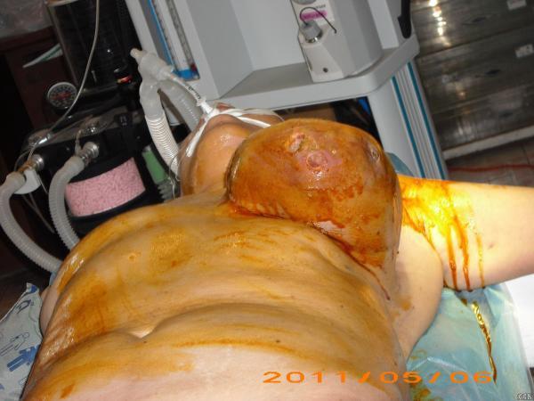 巨大乳腺肿瘤手术过程(图片)