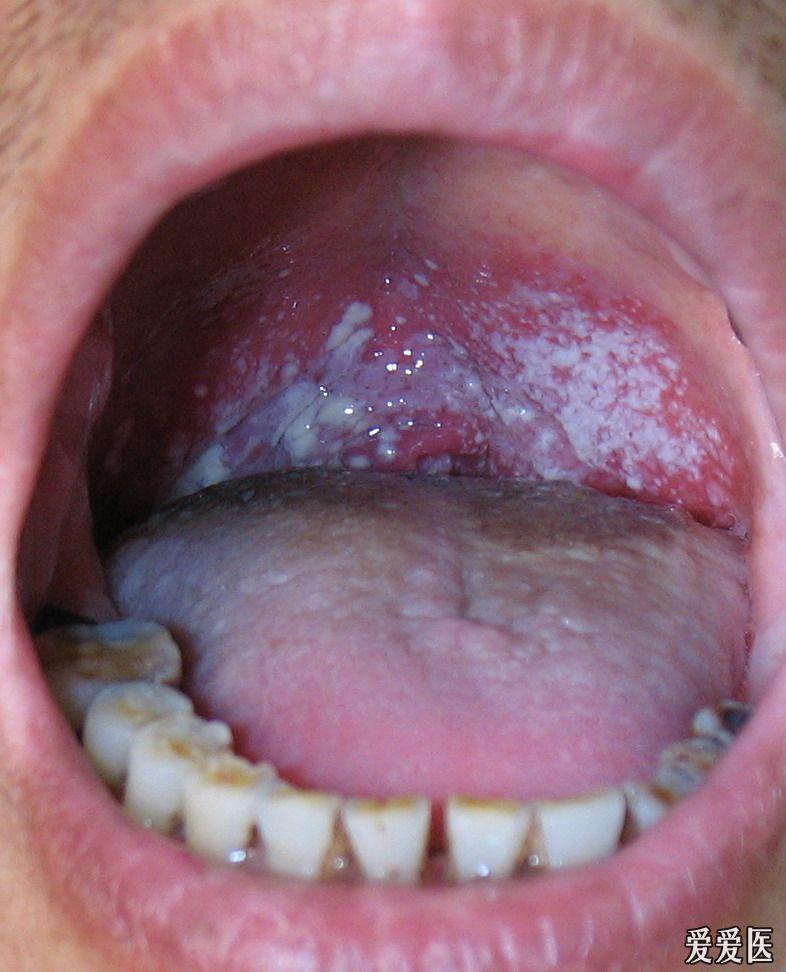 65岁男性 霉菌性口腔炎(治疗效果图片已经上传)