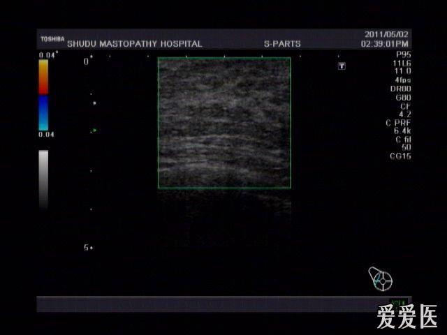 05-16 22:07:03女,27岁,哺乳期,低热,左侧乳房上象限皮肤红肿热痛