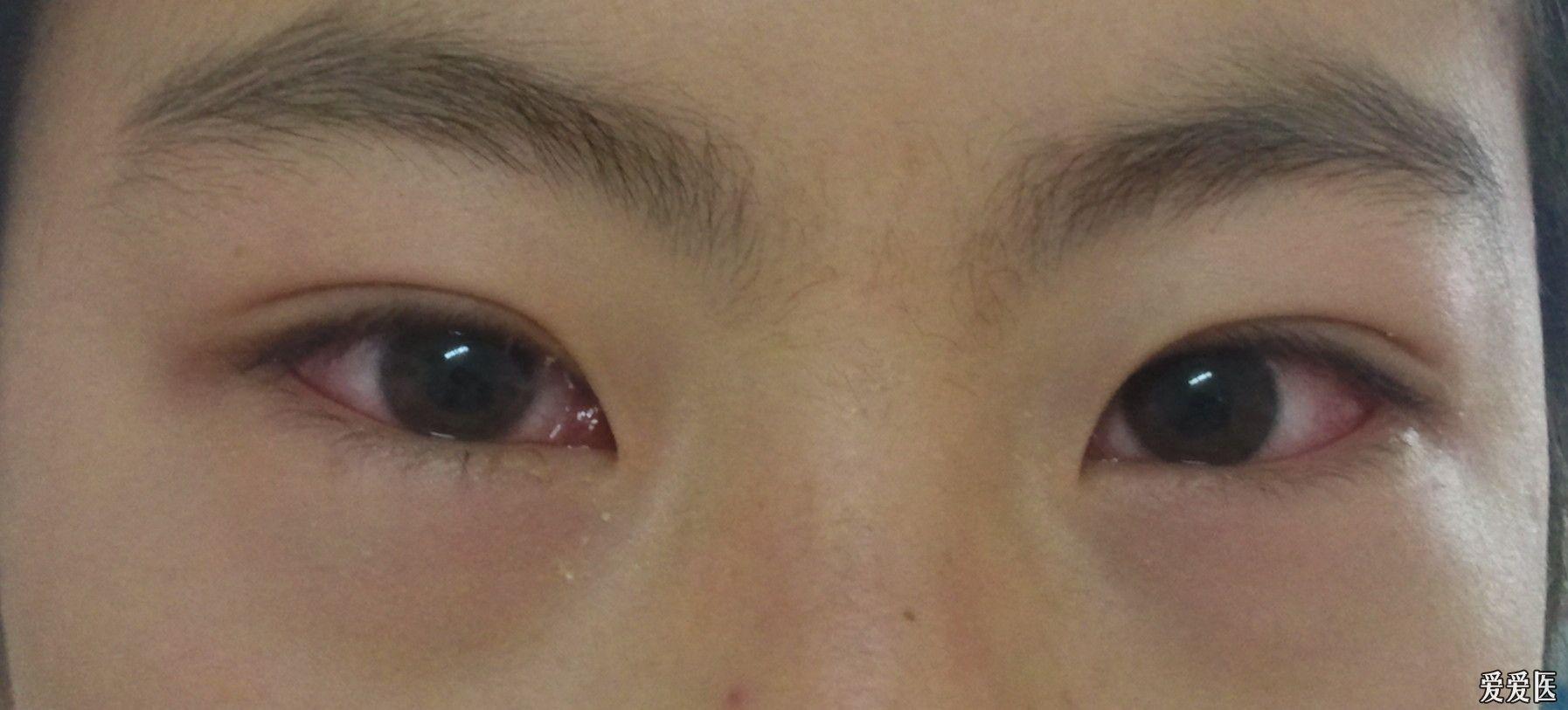 急:咽结膜热,如何处理?在线求助.