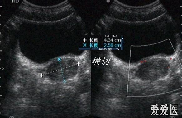 这个子宫怎么回事?