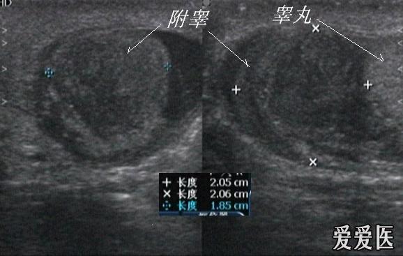 急性附睾炎? - 超声医学讨论版 - 爱爱医医学论坛-医