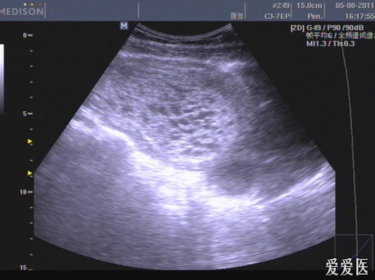 一个意想不到的葡萄胎 - 超声医学讨论版 - 爱爱医医学论坛-爱爱医