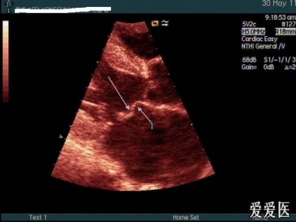 23:20:37二尖瓣脱垂综合征,一般女多于男,后叶多于前叶,年轻女性多见图片