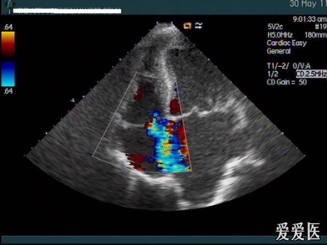 2011-27考虑二尖瓣脱垂综合征1例