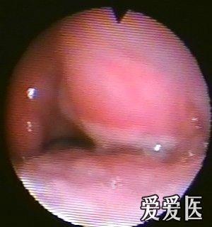 扁桃体,喉部白斑? - 耳鼻咽喉-头颈外科专业版 - 医