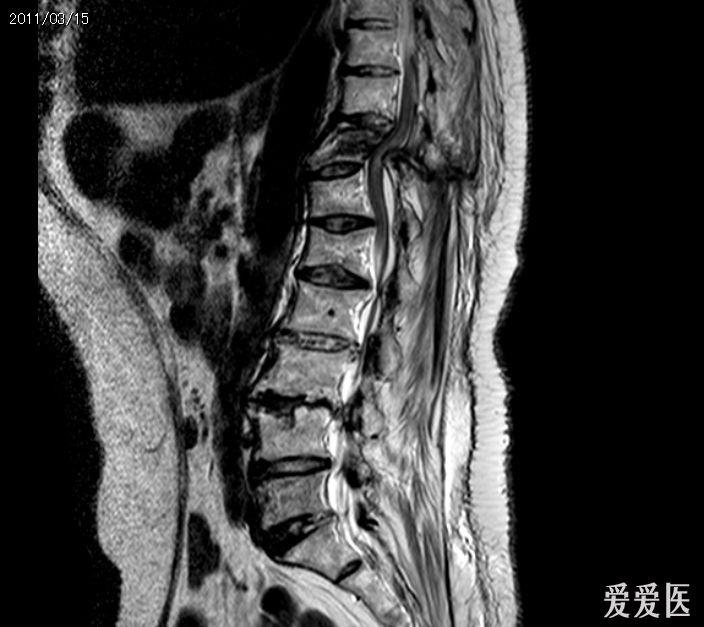 非典型重度chance骨折一例