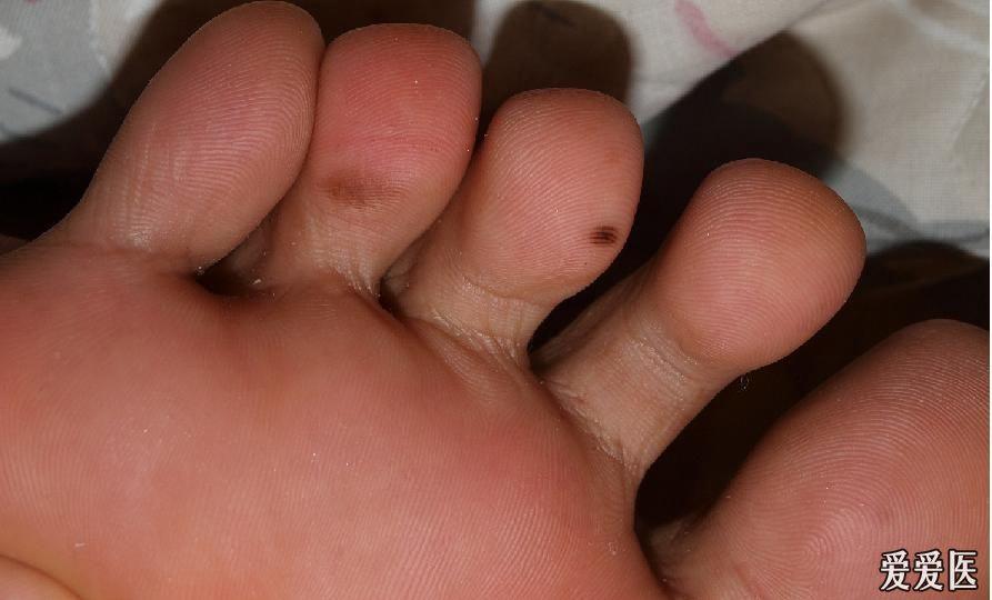 首先是脚趾上的痣 病理报告显示 交界痣(切缘净 其次是脚趾上的色素