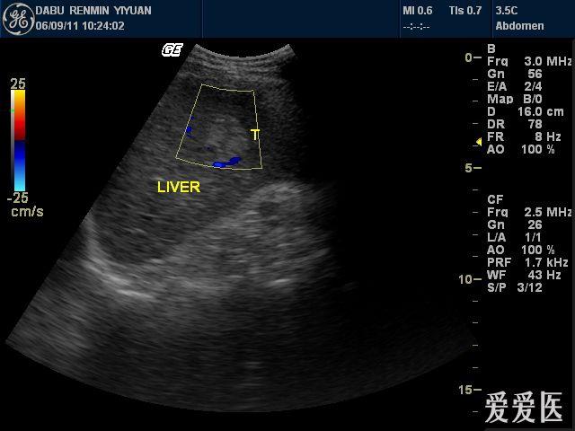 肝血管瘤 - 超声医学讨论版 - 爱爱医医学论坛 - 爱爱