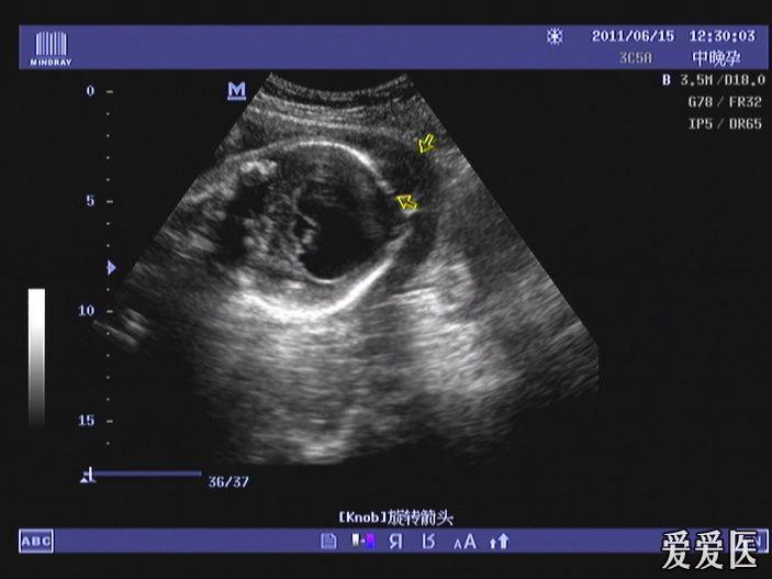 胎儿脑积水伴脑膜膨出 - 超声医学讨论版 - 爱爱医