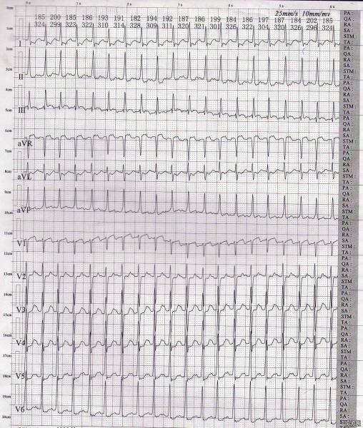 是室上速,还是房扑呀,请分析下这份心电图