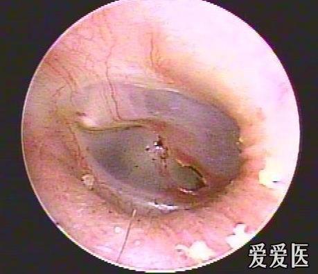 外伤性鼓膜穿孔的治疗(经验谈)