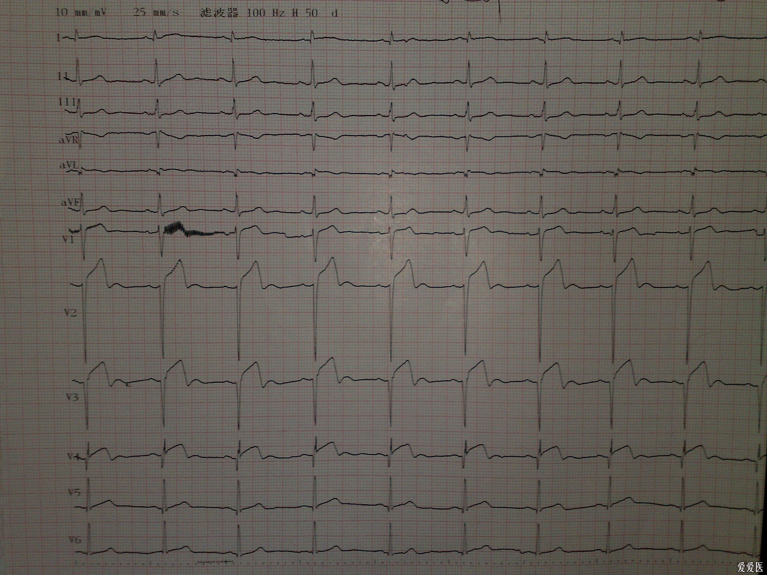 急性广泛前壁心肌梗死的典型心电图动态改变