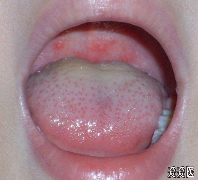楼主yjb52001202011-07-02 23:19:23   近些天诊治了几例口腔溃疡伴