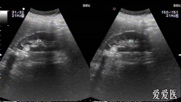 肾错构瘤2例. - 超声医学讨论版 - 爱爱医医学论坛