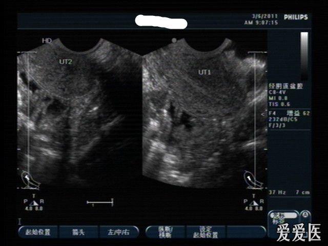 【点评】残角子宫的超声影像图讨论,同时做出了分析,对于爱友的学习有