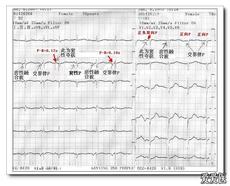 山羊老师课程常见心电图基础知识讲座第四讲——p波方向来源分析