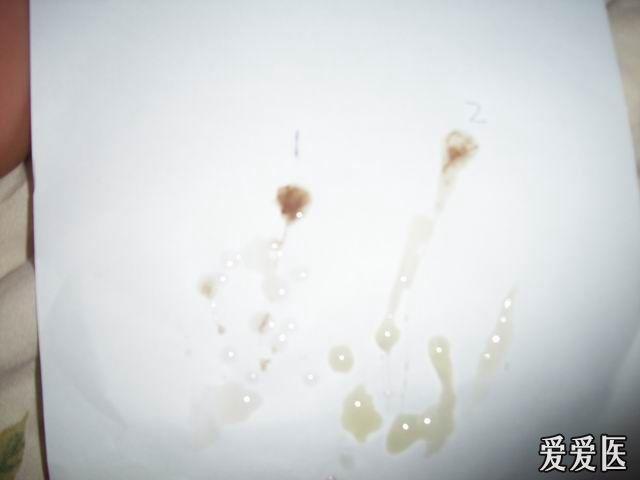 精液呈黑褐色,间断治疗一年,效果不明显,请专家支招(附图)