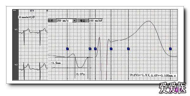 山羊老师课程常见心电图基础知识讲座第五讲——p波时限与电压