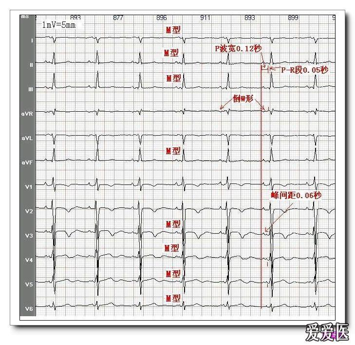 山羊老师课程常见心电图基础知识讲座第五讲——p波时限与电压