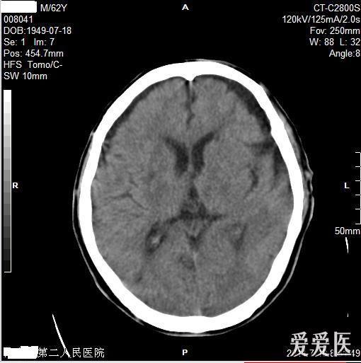 慢性硬膜下血肿 or 脑萎缩?