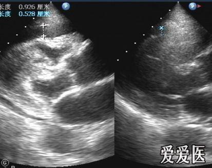 心包积液 - 超声医学讨论版 - 爱爱医医学论坛 - 爱爱医医学网