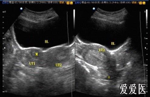 双角子宫合并泌尿系统畸形--单侧肾 - 超声医学讨论版