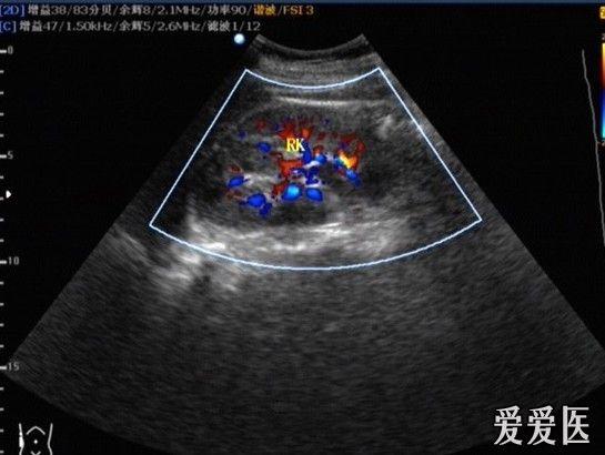 双角子宫合并泌尿系统畸形--单侧肾 - 超声医学讨论版