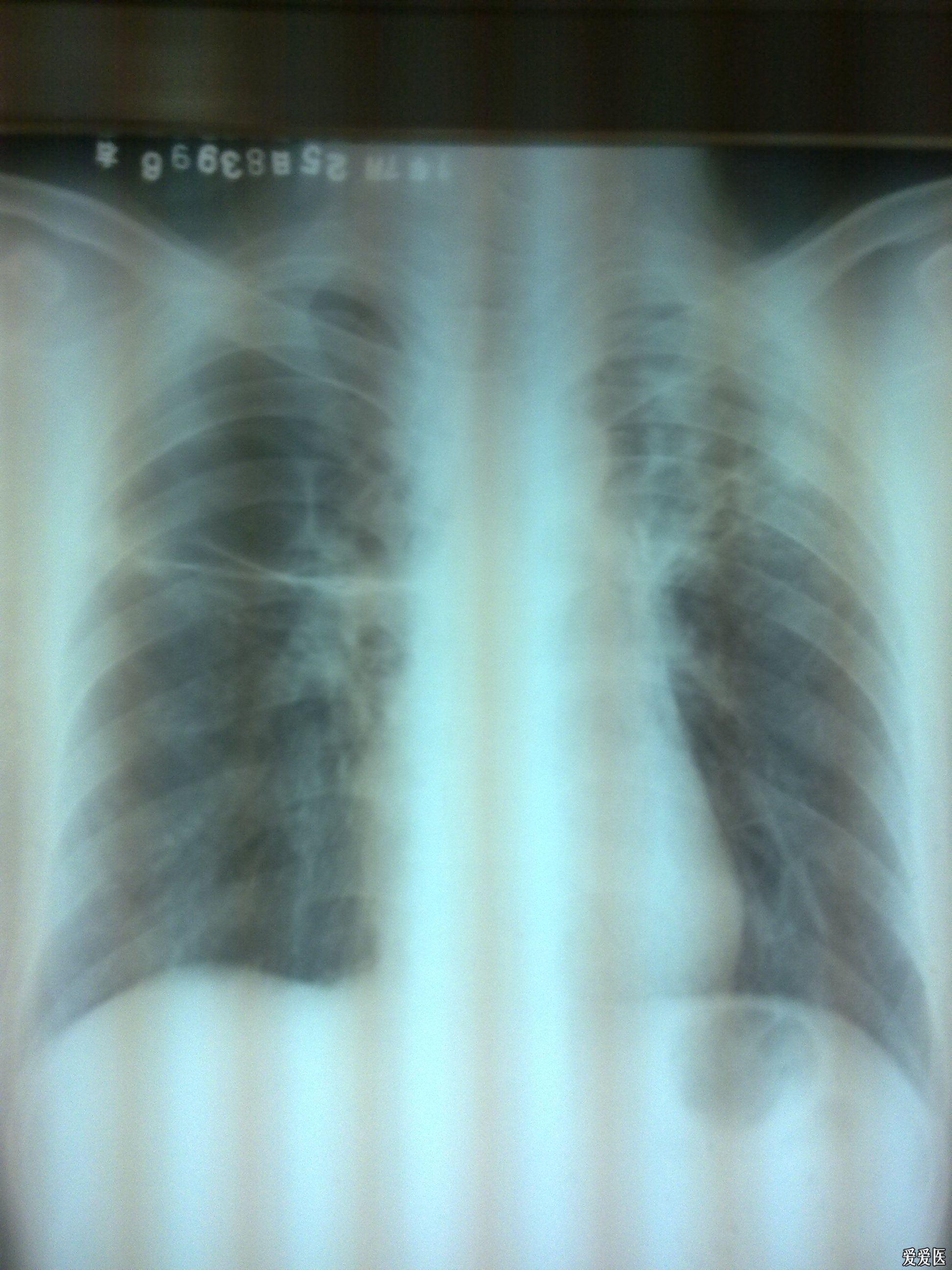 基层肺部x光片,高人来看看