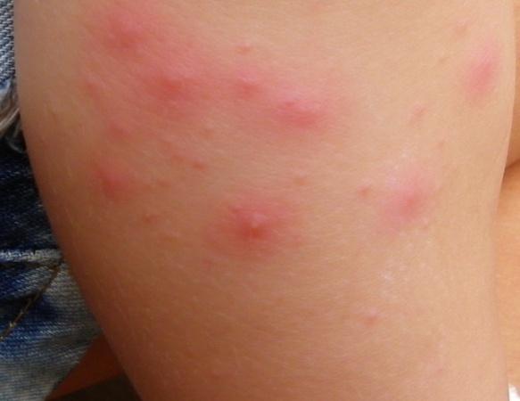 考虑是痱子,但是皮疹中心有小脓点,又觉得是水痘,下午小儿发烧38.