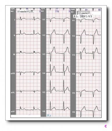如rv3>1/2rv4;③同一导联的r波振幅在不同次的心电图记录中呈进行性