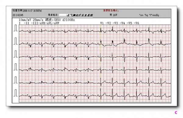 如rv3>1/2rv4;③同一导联的r波振幅在不同次的心电图记录中呈进行性