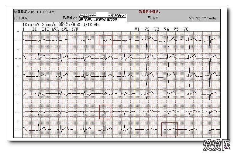 如rv3>1/2rv4;③同一导联的r波振幅在不同次的心电图记录中呈进行性