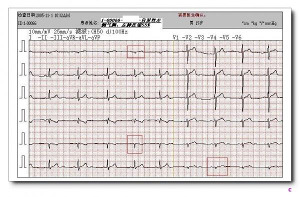 山羊老师课程常见心电图基础知识讲座第九讲—有关q波知识