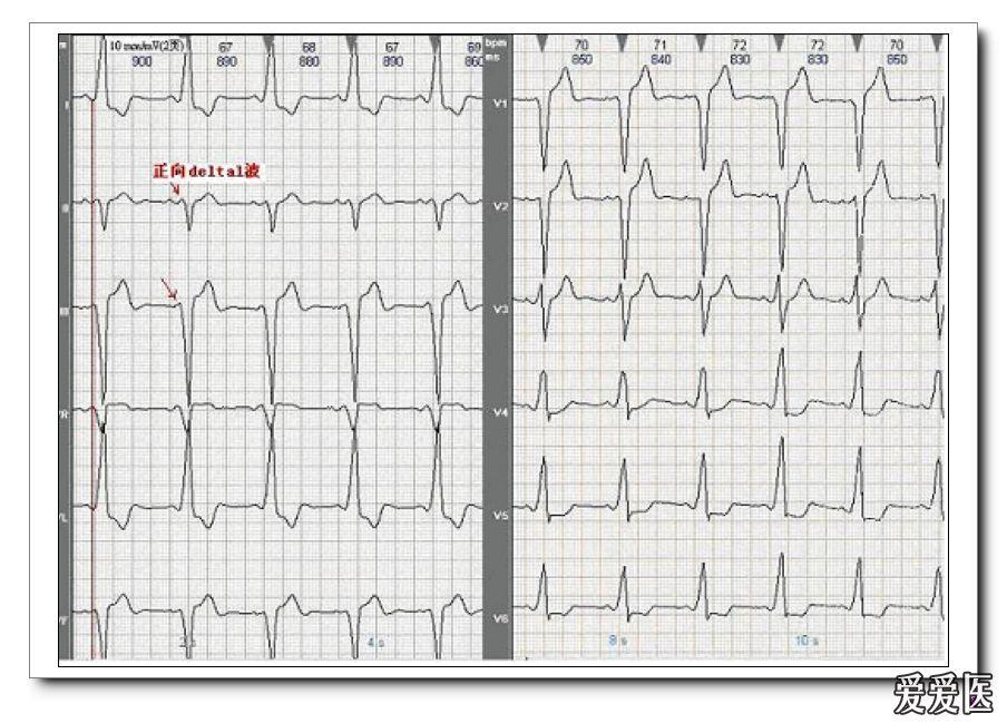 如rv3>1/2rv4;③同一导联的r波振幅在不同次的心电图记录中呈进行性
